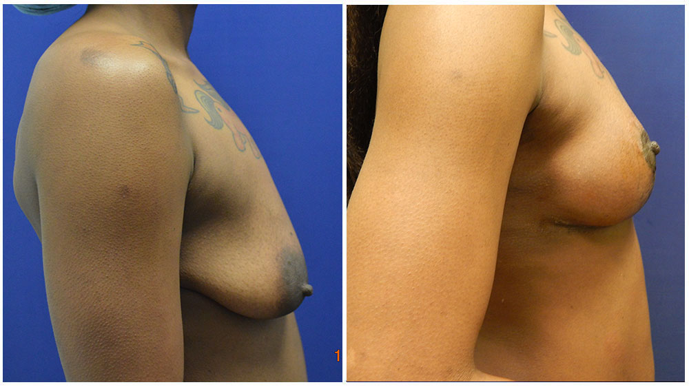 Fat Transfer Breast Augmentation Patient (32 Years)